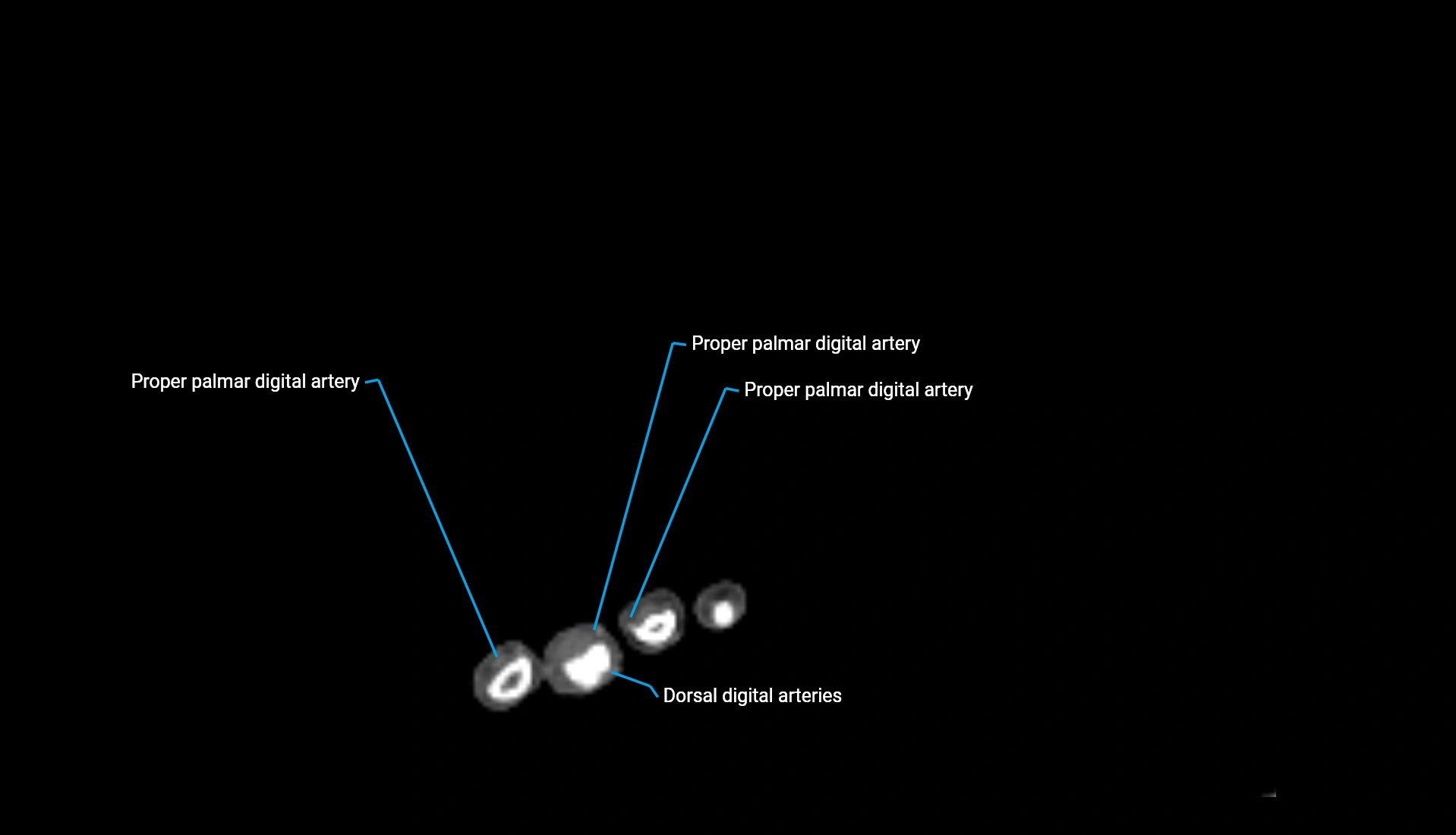 CTA upper limb axial cross sectional anatomy labelled image 23 (2).webp